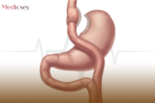 Gastric Sleeve in Turkey Price Medicsey.png